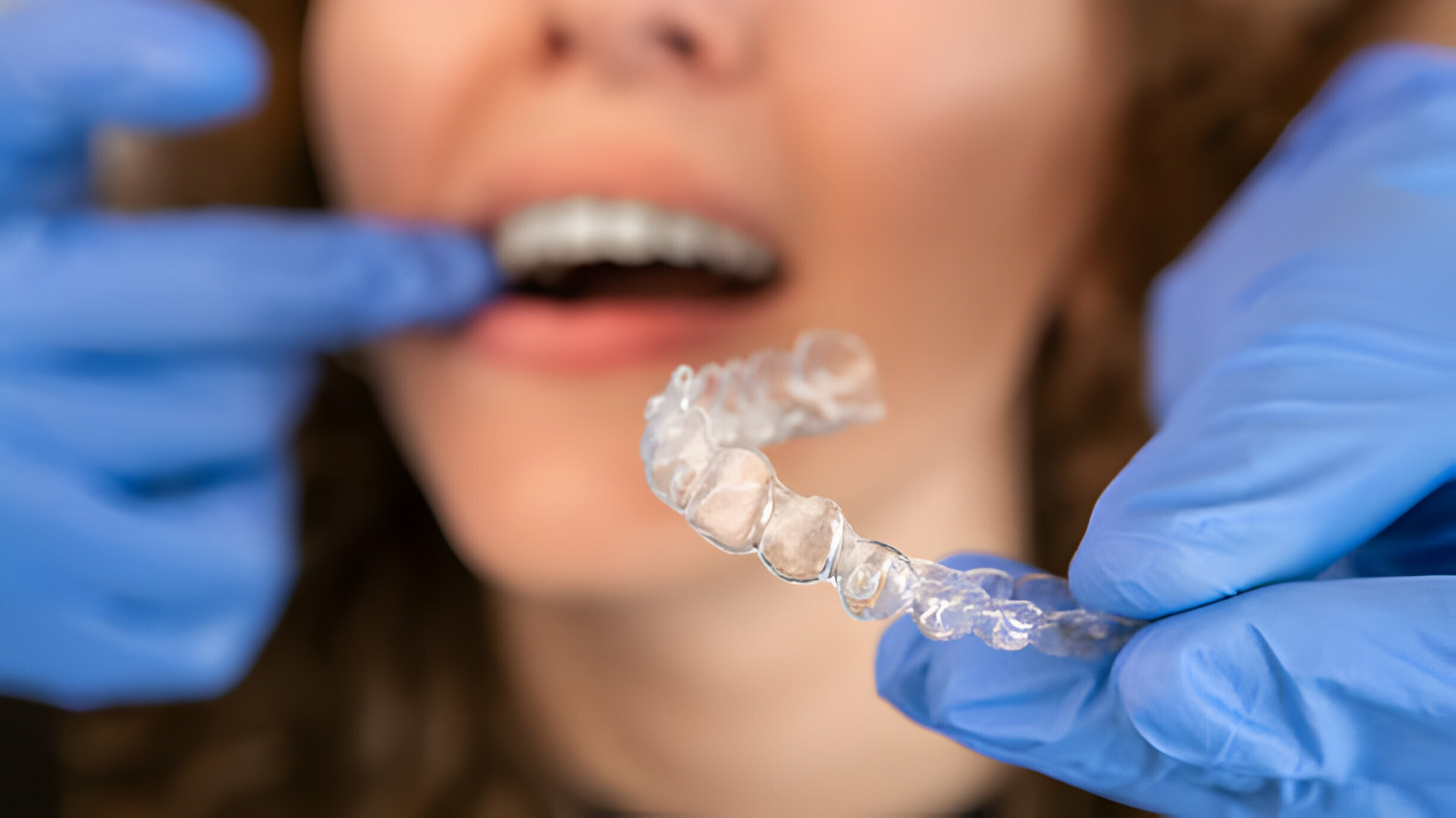 Invisalign in San Antonio: A Modern Approach to Orthodontic Treatment_FI