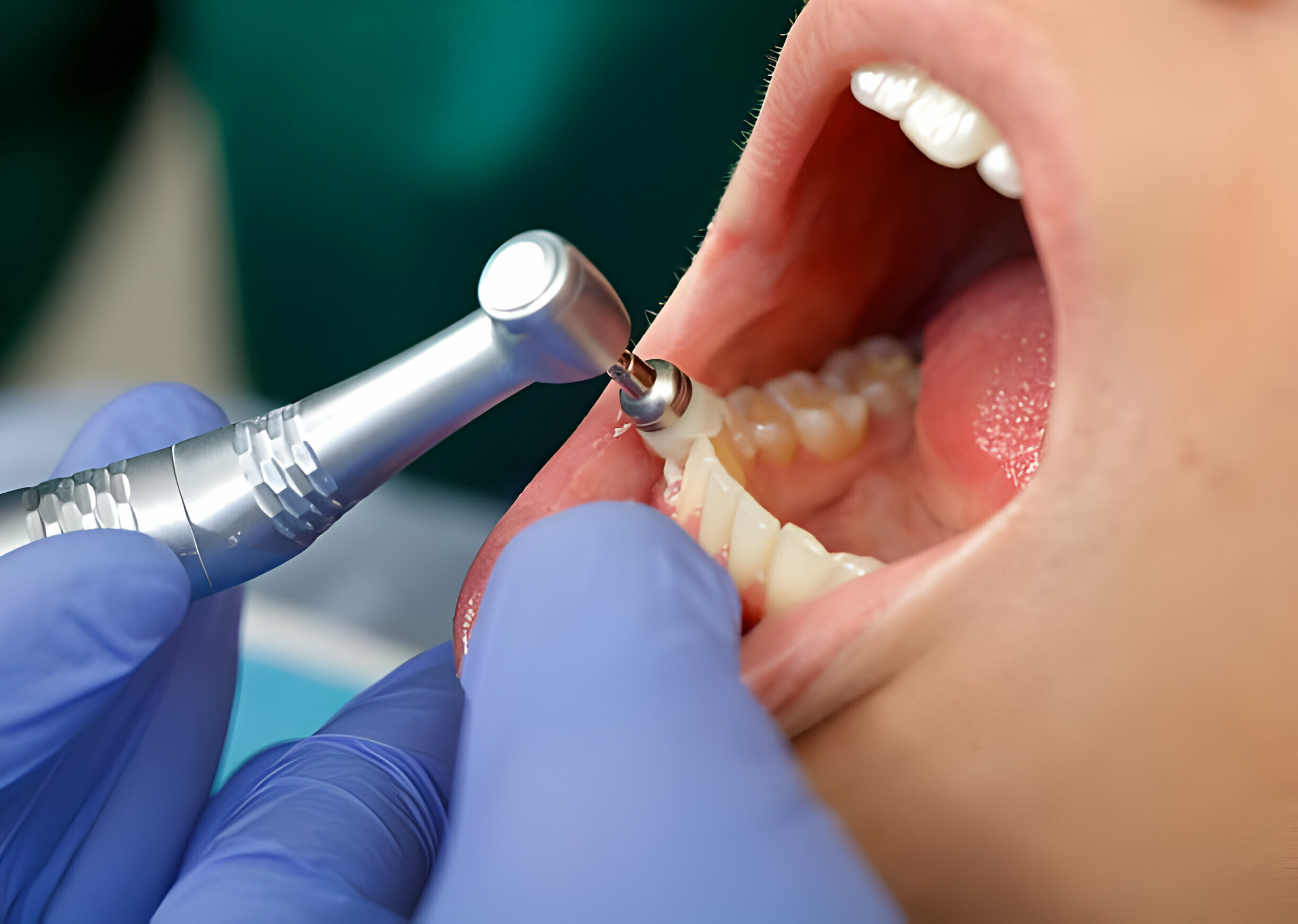 Understanding Dental Cleanings: How Long Should They Take_FI