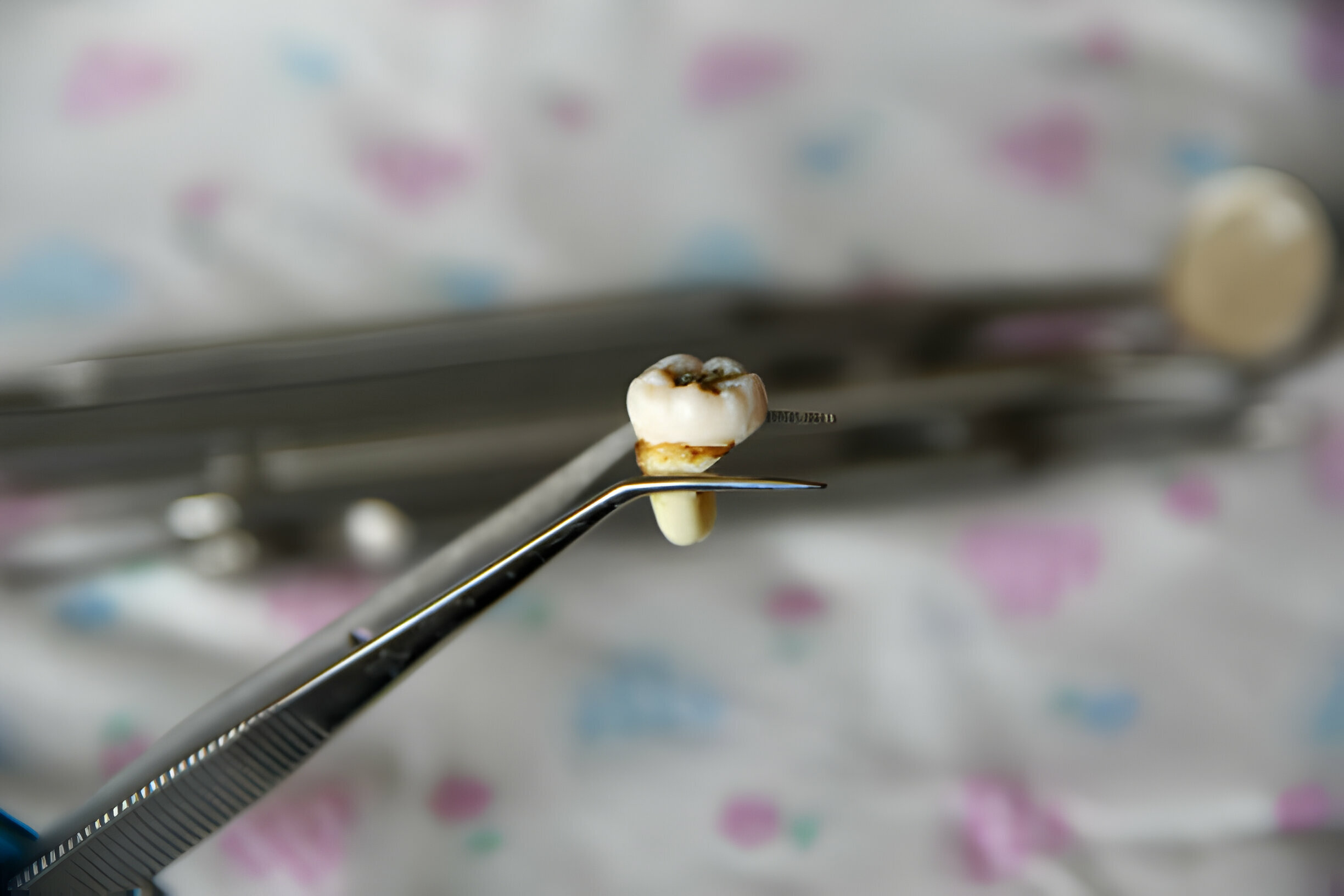 Tooth Extraction In San Antonio: A Comprehensive Guide_FI