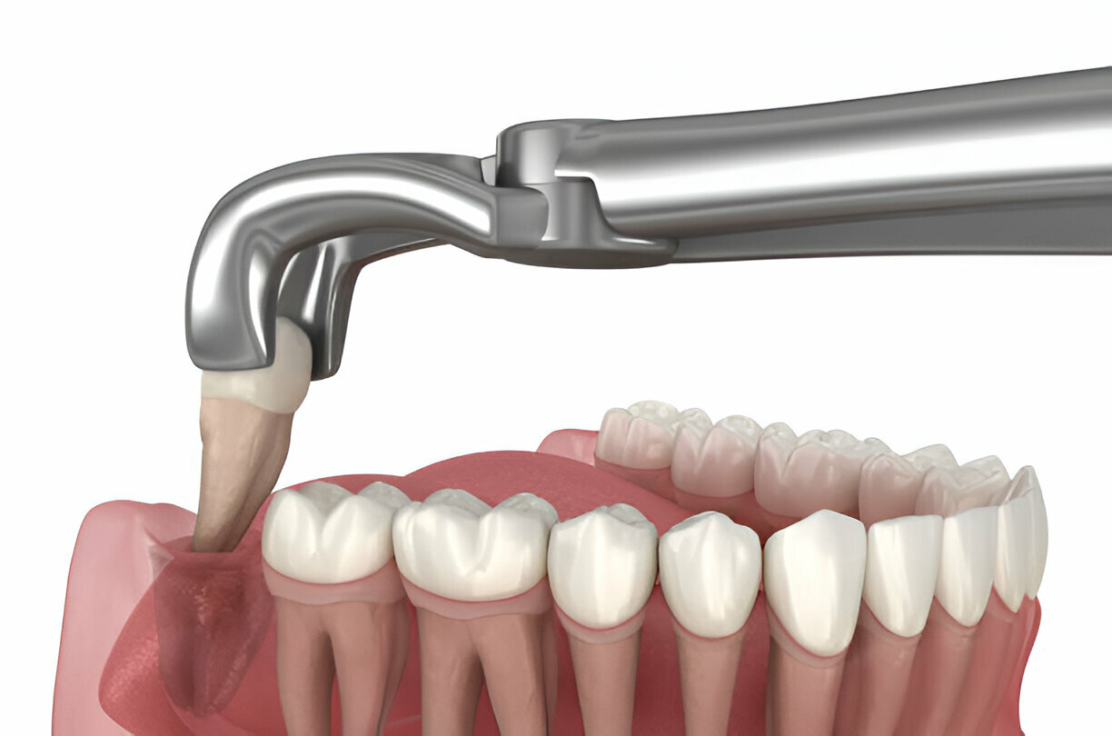 Teeth Extractions and Pain Management: Tips for a Smooth Recovery_FI