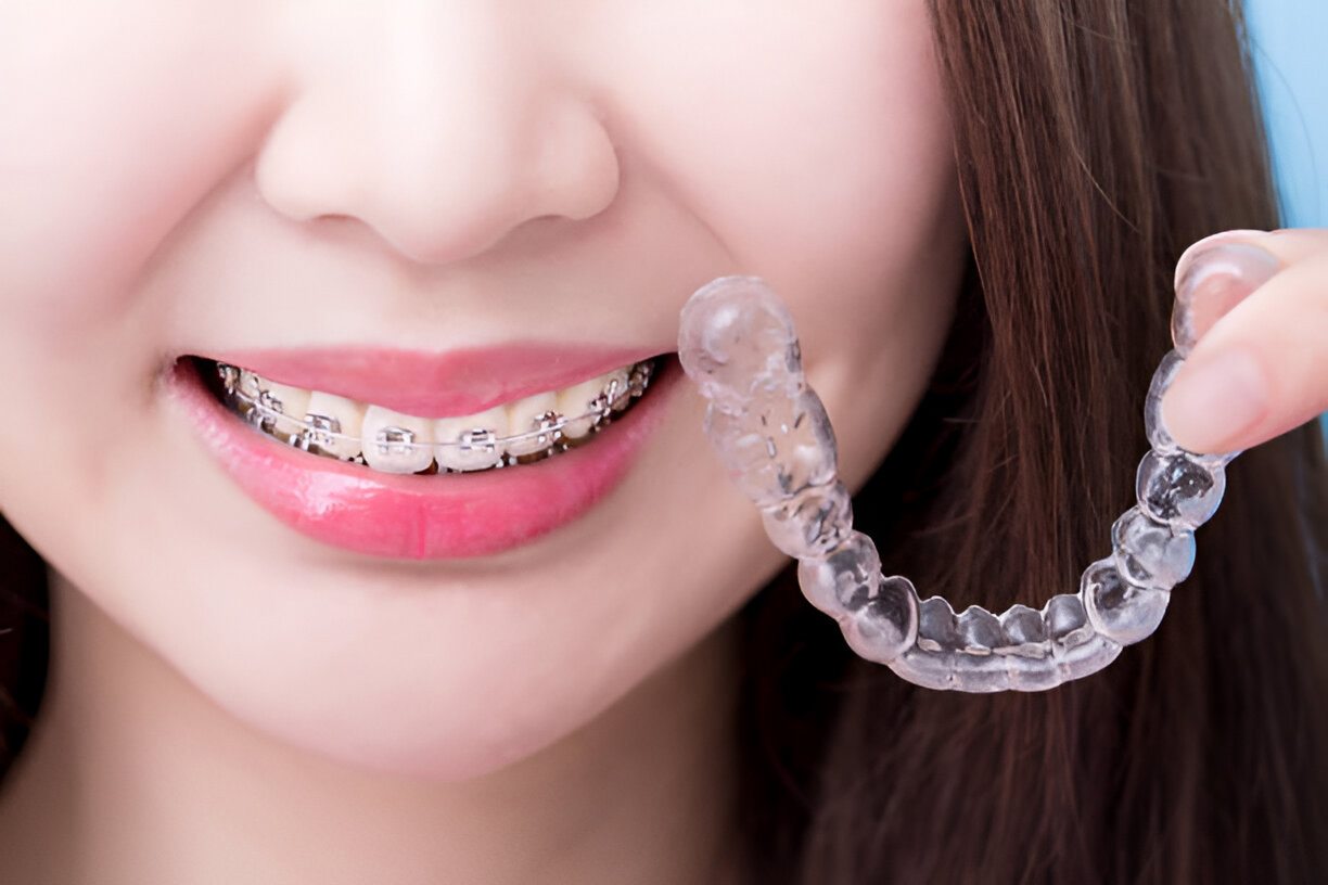 How to Choose the Right Orthodontic Treatment for Your Smile_FI