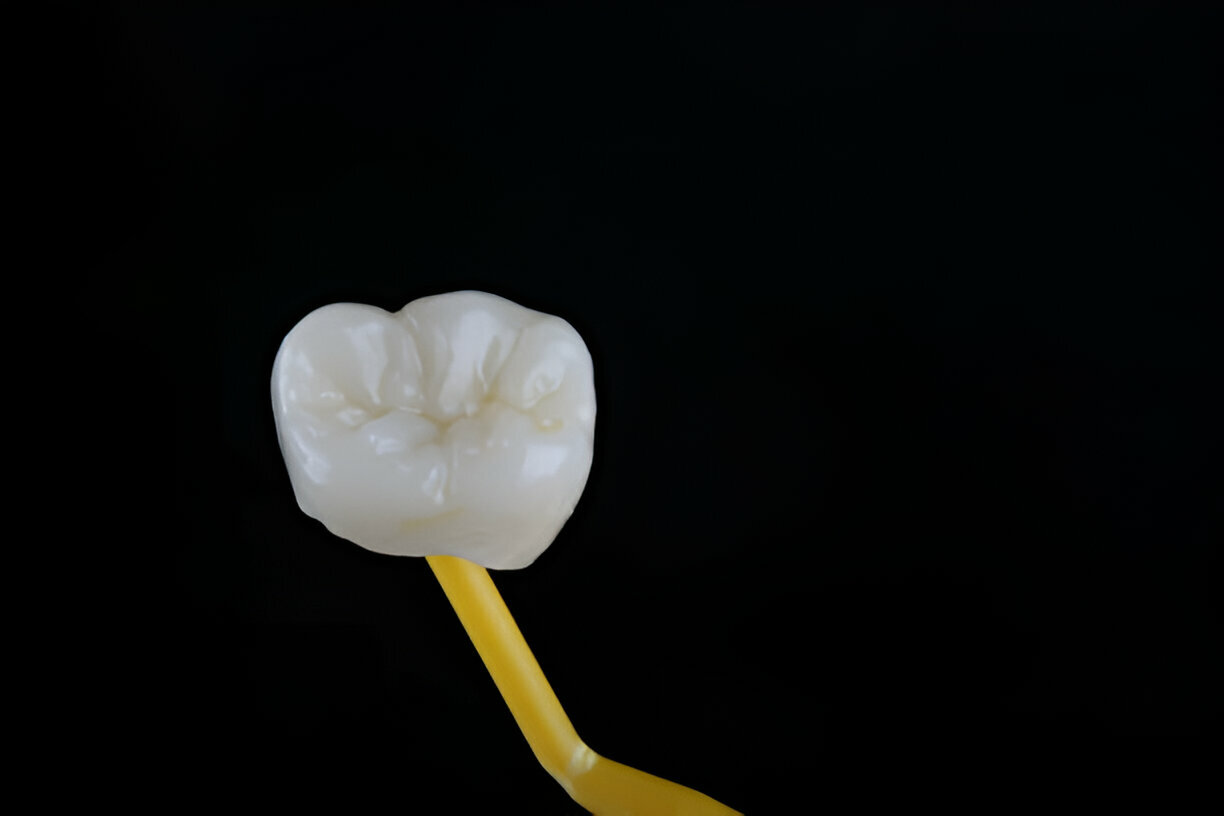 Choosing the Right Dental Crown: A Complete Guide by Heritage Dental in San Antonio, TX_FI