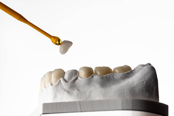 Same-Day Dental Crowns in San Antonio TX Heritage Dental’s CEREC Technology