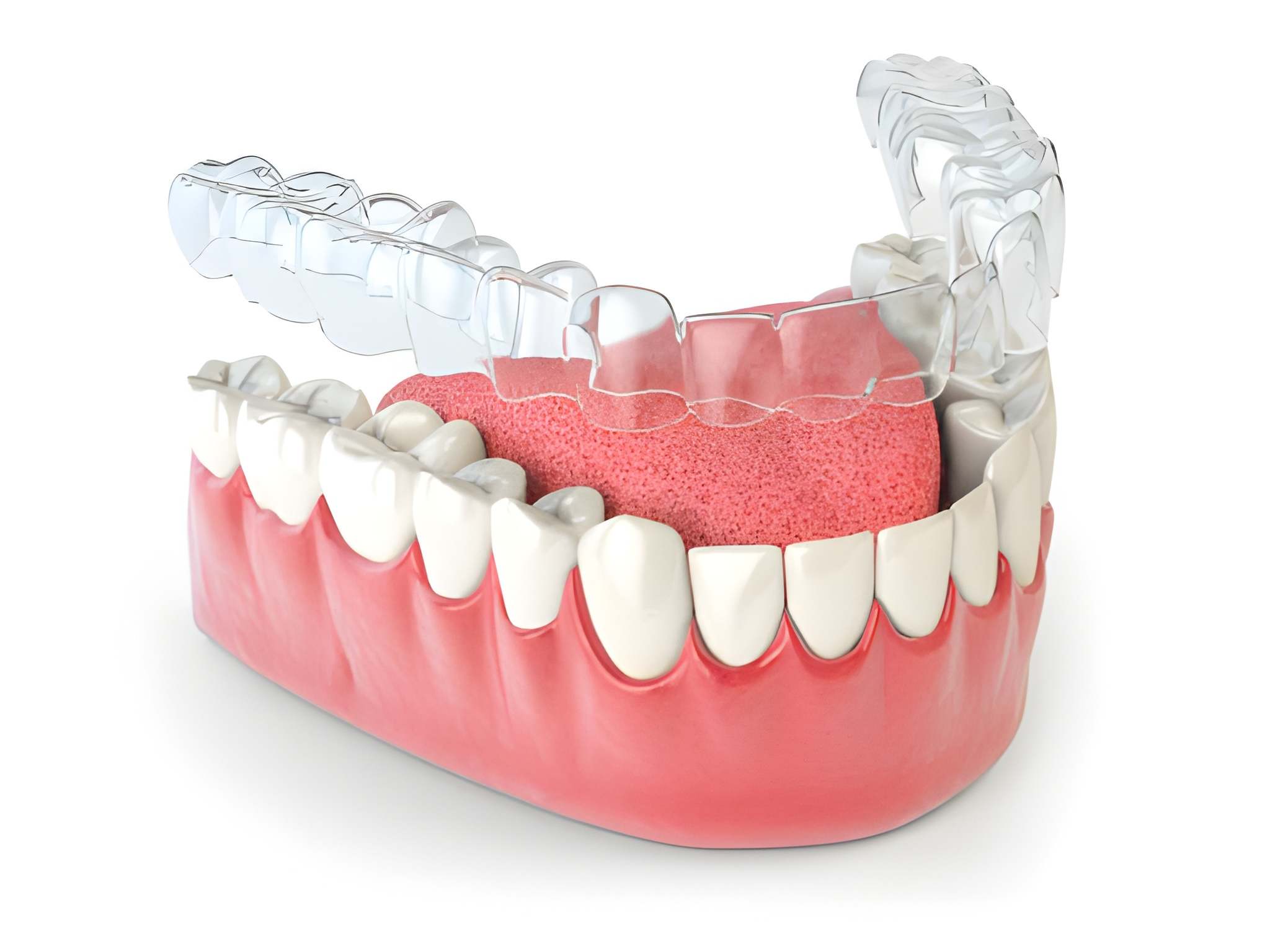 Straighten Your Smile with Invisalign at Heritage Dental in San Antonio_FI