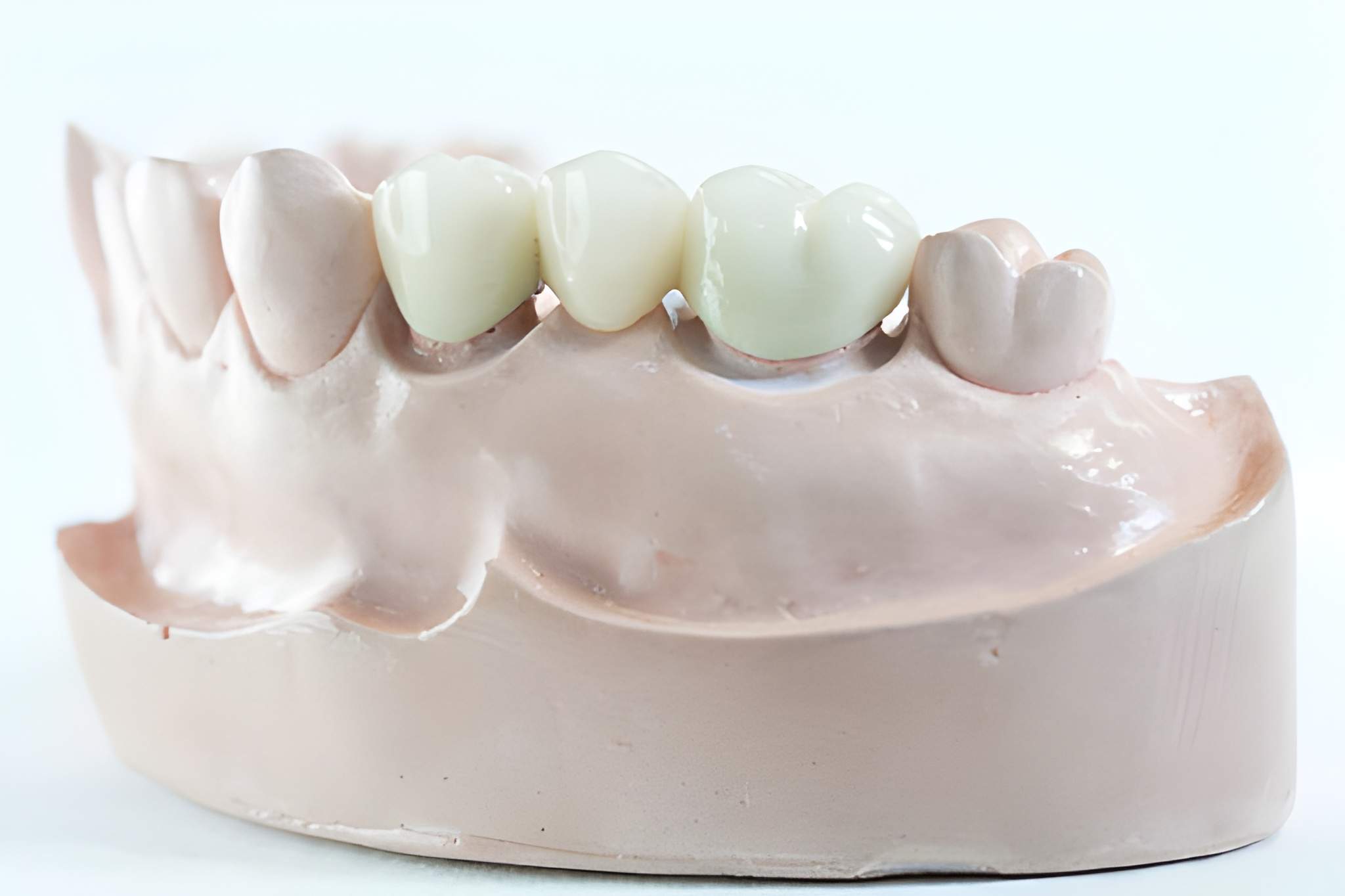 How Dental Bridges Work - San Antonio Dentist Explains Your Options_FI