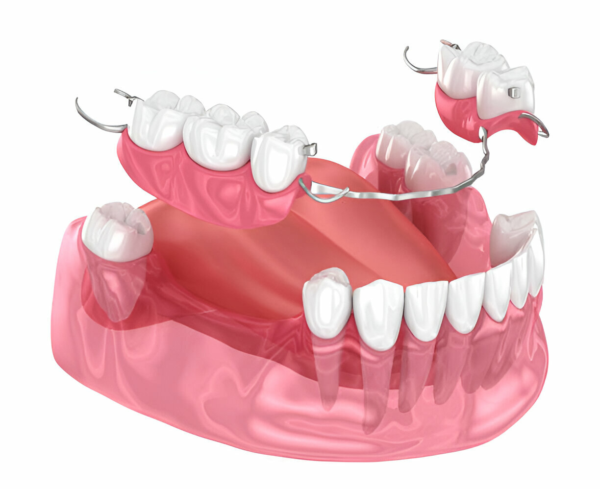 Full vs. Partial Dentures: Which Option Is Right for You? San Antonio Dentist Explains_FI